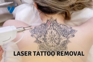 Laser Tattoo Removal