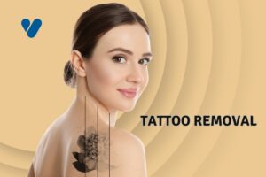 Tattoo Removal