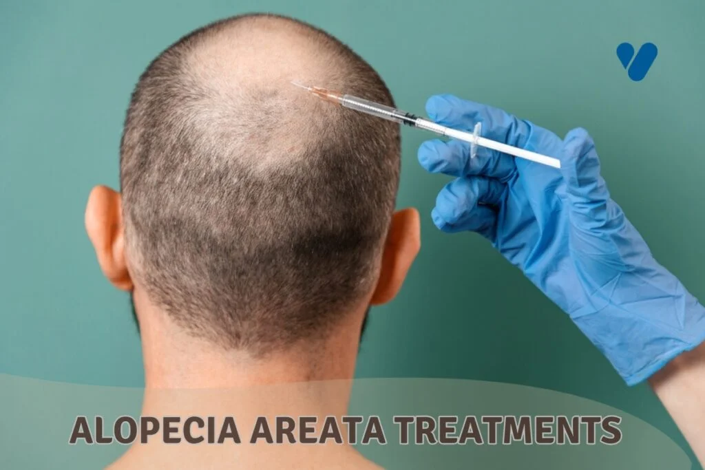 Alopecia Areata Treatments