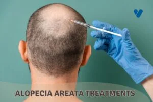 Alopecia Areata Treatments
